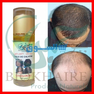 زيت الصلع